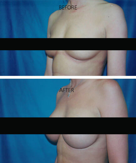 Breast Augmentation Ashville NC