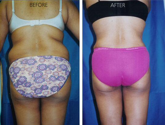 Areas of the Body Liposuction Can Improve