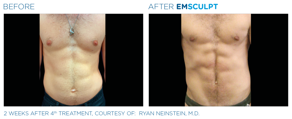 Non-Invasive Body Contouring & Muscle Building Treatments